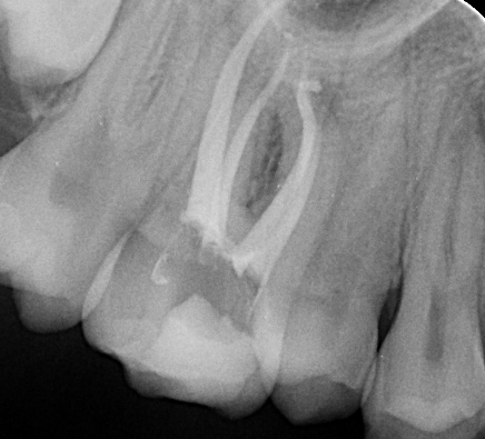Endodonție
